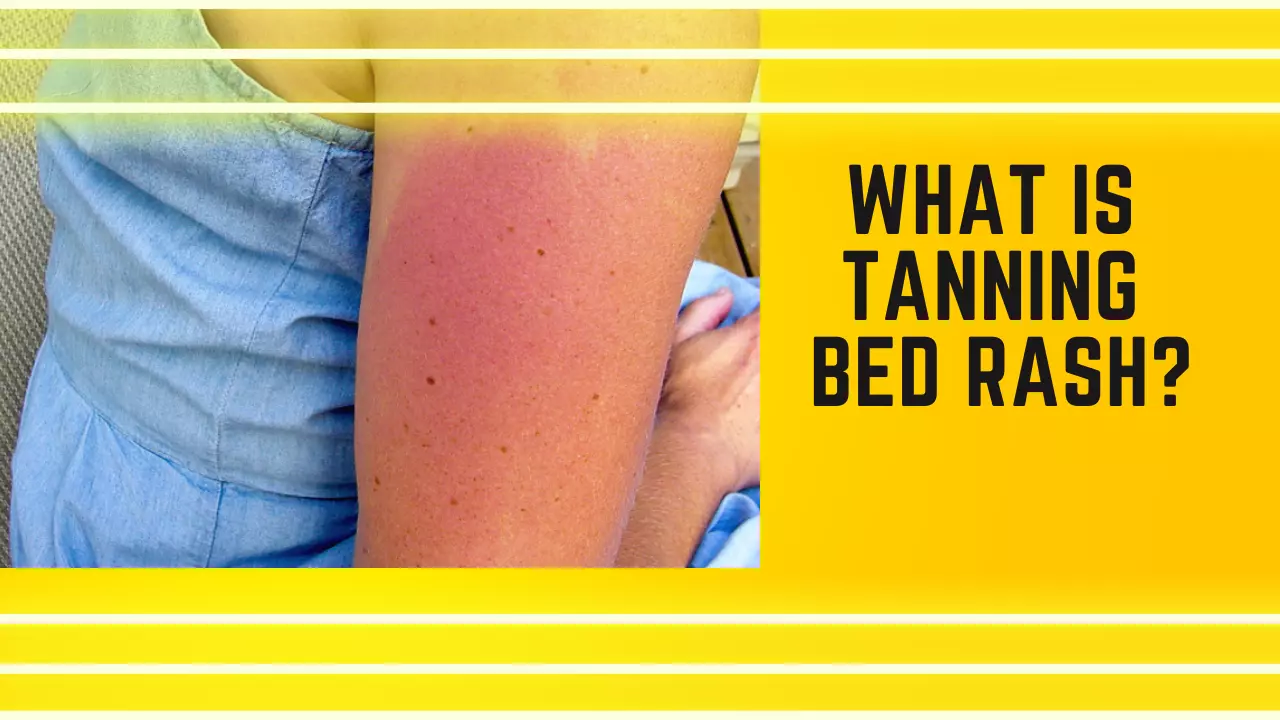 Red bumps from tanning bed